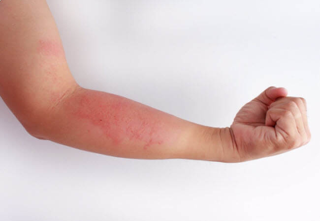 Екзема у дітей. Як боротися із запаленням шкіри?
