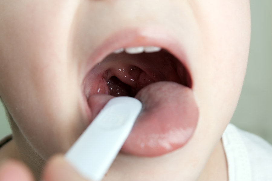 Народні засоби для капання в ніс при аденоїдах у дітей