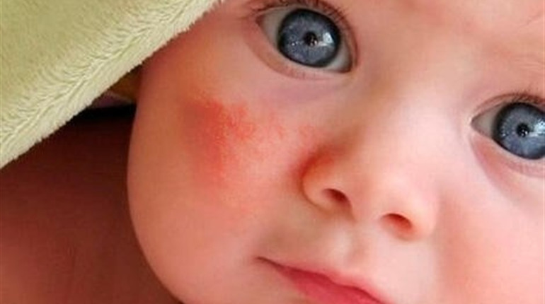 10 продуктів, які найчастіше викликають алергію у малюків