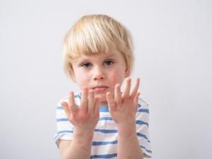 Атопічний дерматит у дітей (АД) – розвінчуємо 5 популярних міфів